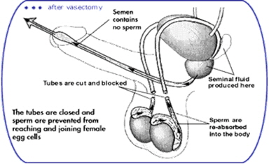 Vasectomy Diagram